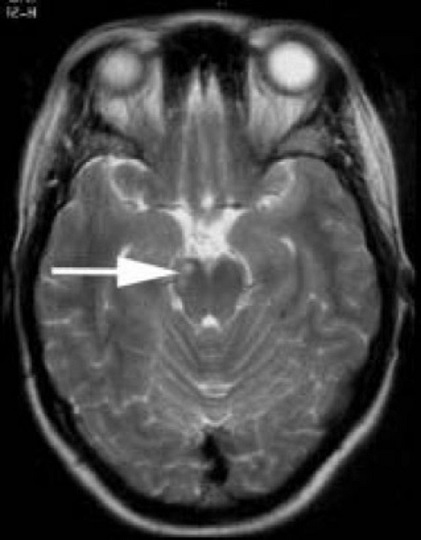 (2020) Neurossífilis: sintomas, causas, tratamentos - Maestrovirtuale.com. (Disponível em 9/12/2024)